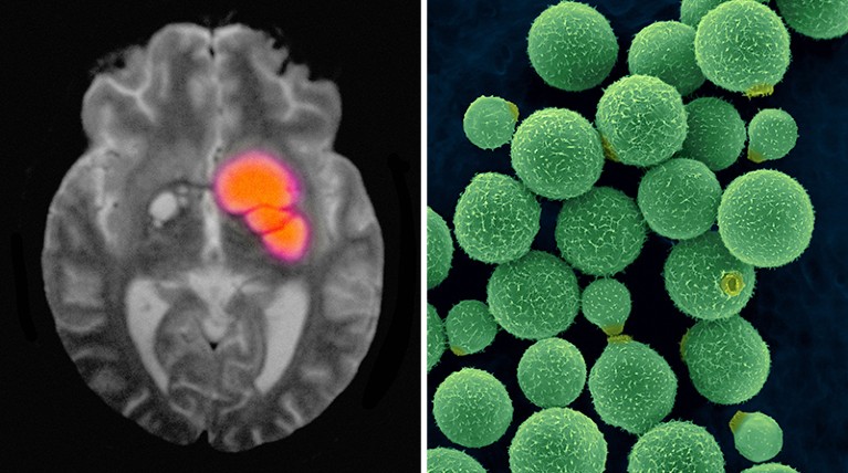 Image on left: black and white brain image with orange area to the right of centre. Image on Right: green spherical fungus particles of varying sizes, on dark background