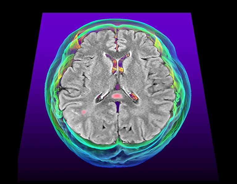 Coloured 2D magnetic resonance imaging (MRI) and 3D computed tomography (CT) scans of the brain of a patient with active covid-19 and multisystem inflammatory syndrome in adults (MIS-A). Lesions (pink) can be seen in the splenium of the corpus callosum (lower centre) and in the cerebral white matter.