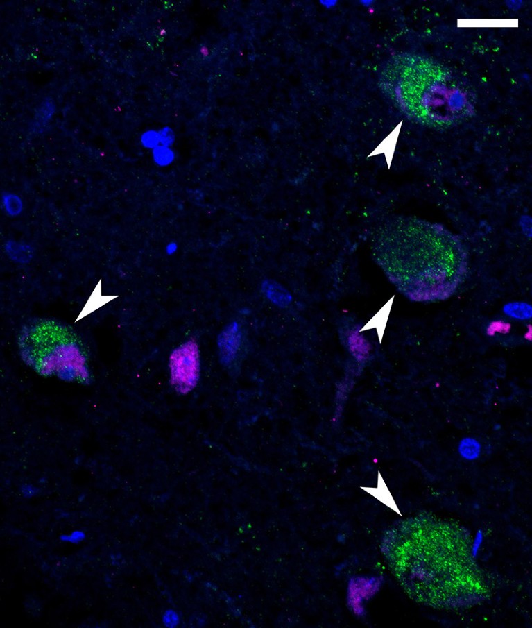 Immunofluorescent image that shows SARS-CoV-2 components (green) specifically in neurons (magenta) in the hypothalamus of the brain of a person who died from COVID-19.