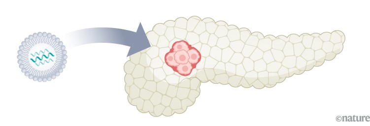 Cellule tumorali del pancreas.