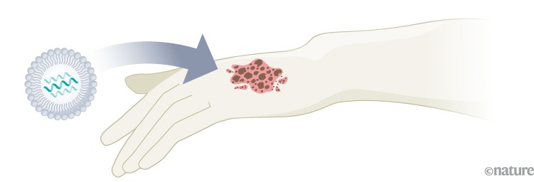Cellule tumorali del melanoma.