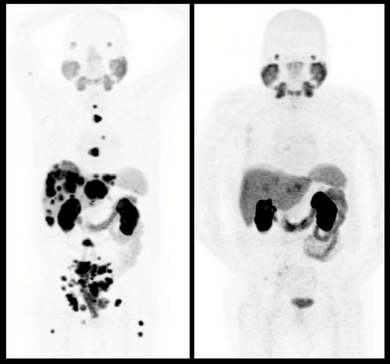 Two body scans showing left with more black markers and right with less markers.