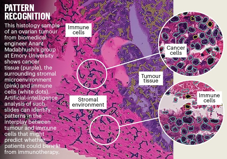 Reconocimiento de patrones: muestra histológica de un tumor de ovario que muestra tejido canceroso, el microentorno estromal y células inmunes