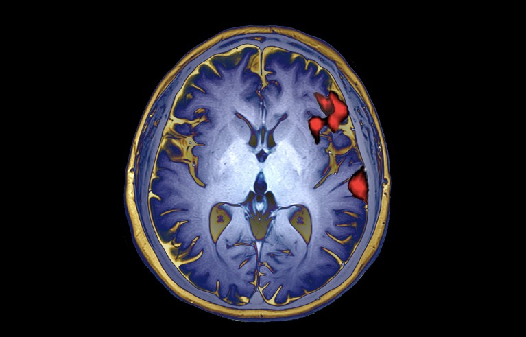 MRI image of brain activity in speech production.