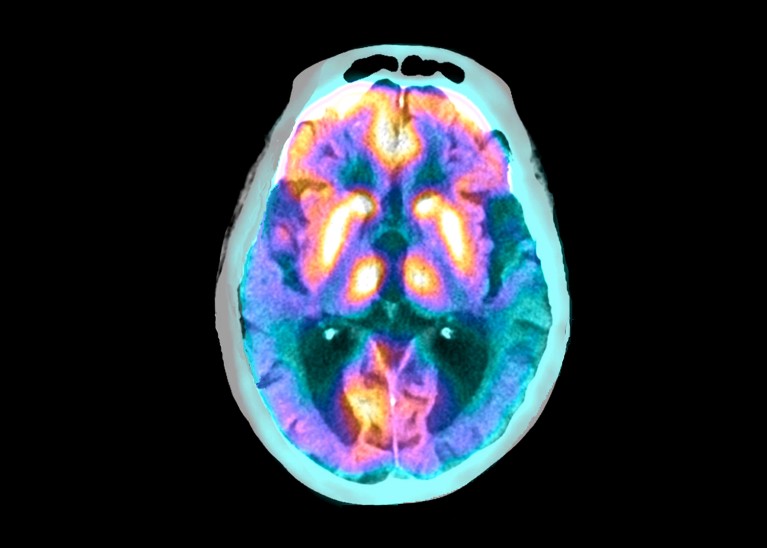 A blue, purple, pink and yellow coloured combined PET and CT scan of a brain with Alzheimer's disease on a black background