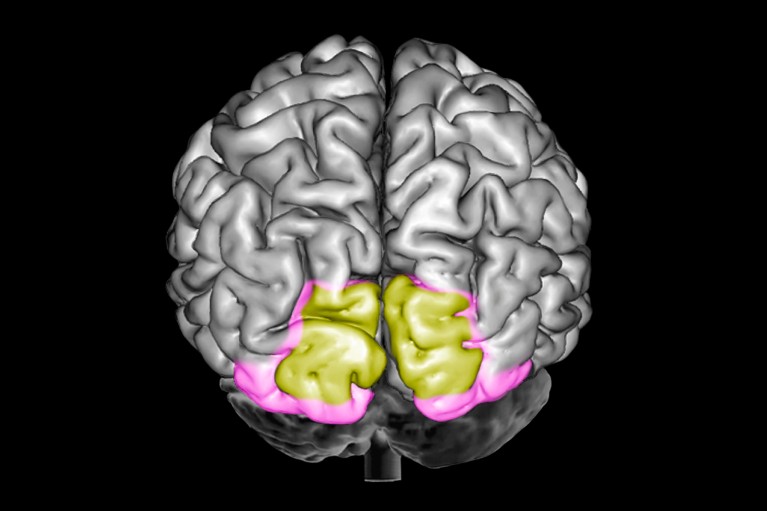 Coloured three-dimensional MRI scan of a brain showing the primary and secondary visual cortex in yellow and pink