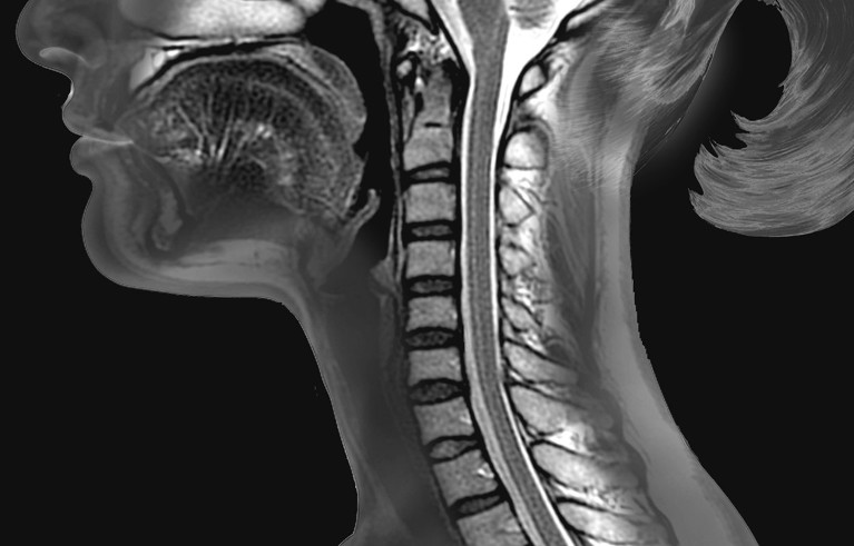 Imagen de resonancia magnética sagital de la columna cervical y el tronco del encéfalo normales de una mujer de 28 años.