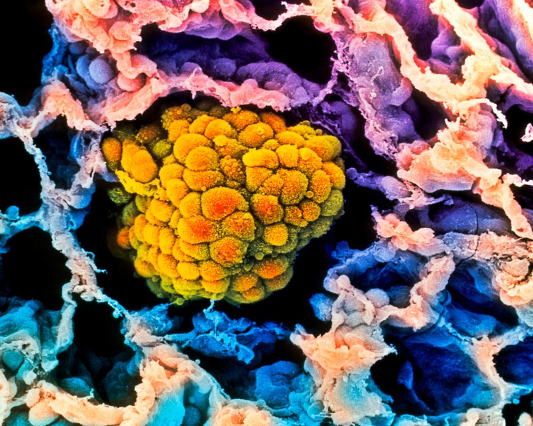 A coloured scanning electron micrograph of an orange cancerous tumour filling an alveolus of a human lung in pink, blue and purple