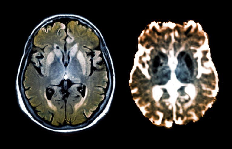 Una imagen compuesta de una resonancia magnética de difusión y una exploración FLAIR del cerebro de un paciente de 47 años, que muestra hiperintensidad alrededor del área de la corteza y los ganglios basales, lo que sugiere