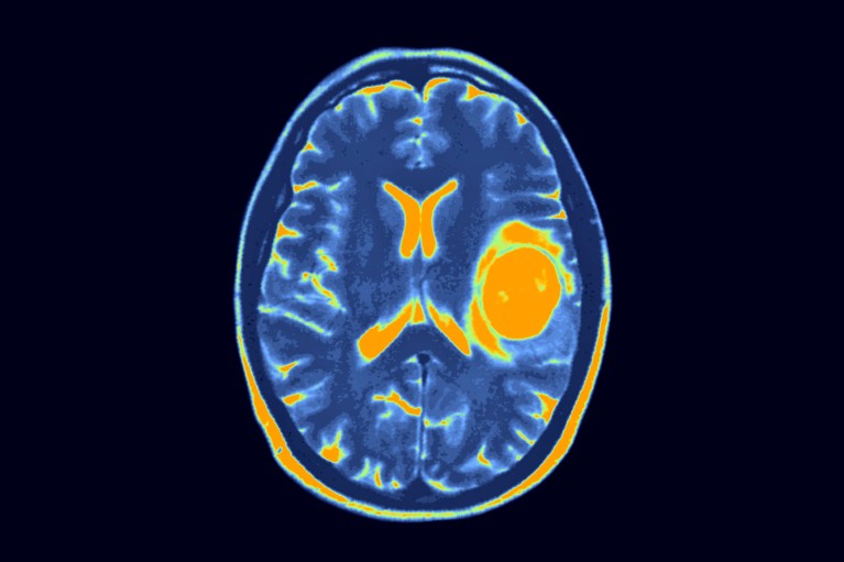 A coloured MRI scan through a brain showing an orange glioblastoma on the right hand side