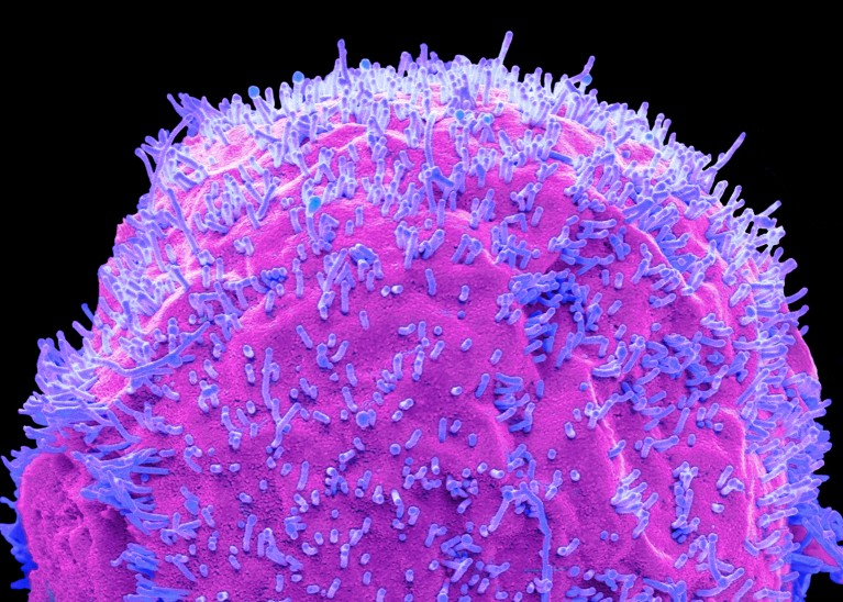 A coloured scanning electron micrograph of human cells infected with bird flu virus, depicted in pink and purple colours