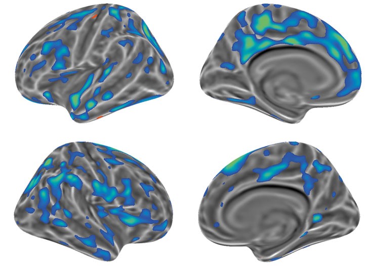 Four brain scans with cortical thickness highlighted in blue.