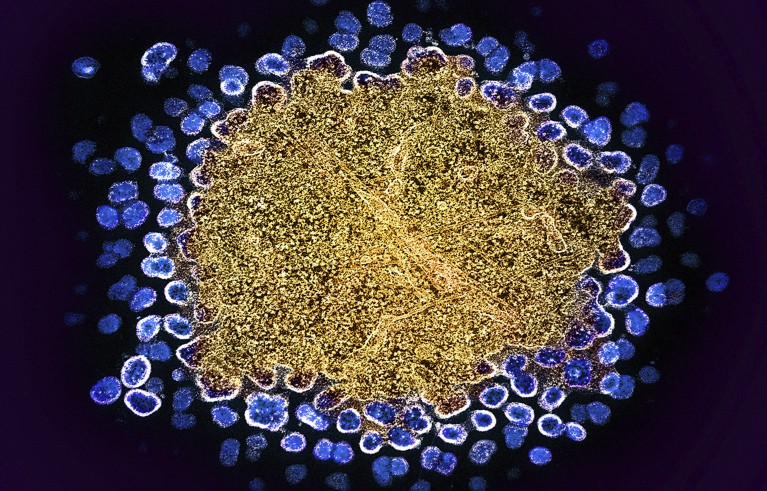 Coloured transmission electron micrograph of HIV particles (blue) budding from the surface of a white blood cell (gold).