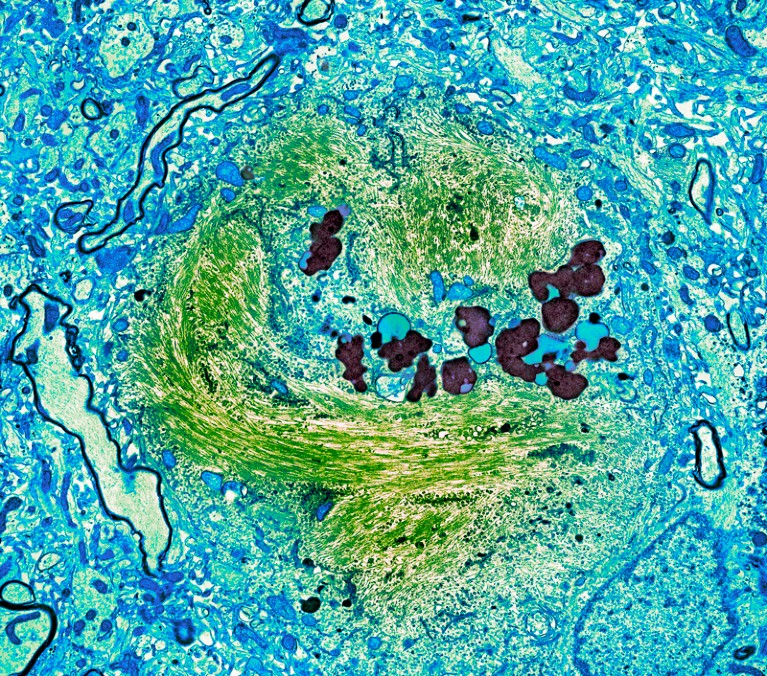 Micrografia eletrônica de transmissão com cores falsas de um agregado anormal da proteína tau no cérebro de uma pessoa com doença de Alzheimer