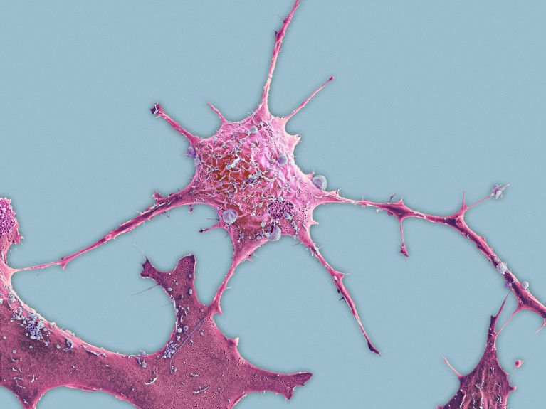 Coloured scanning electron micrograph of a pink breast cancer cell on a pale blue background