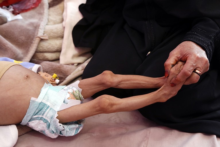 Close up of the outstretched legs of an infant with malnutrition. An adult hand is holding the child's feet.