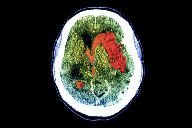 A coloured CT scan showing a bleed on a patient's brain.