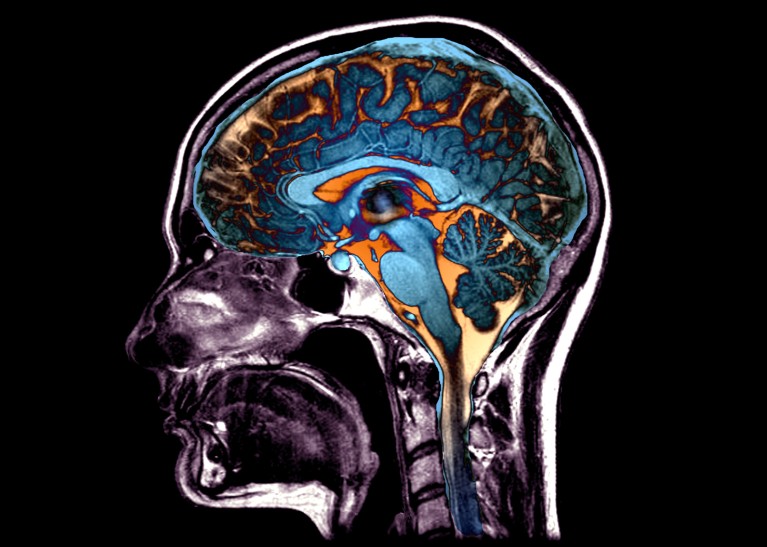 Coloured MRI scan of a human head and brain, with the person facing to the left