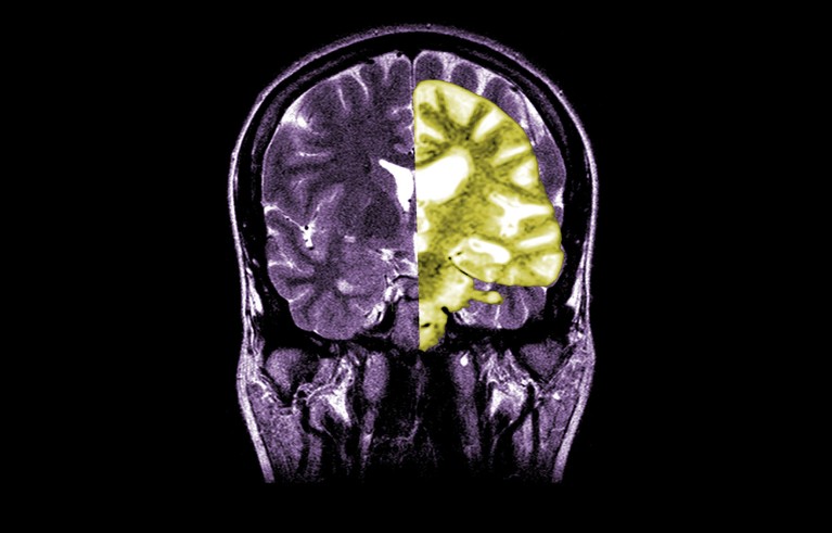 A composite image showing a normal coronal (frontal) cross-sectional MRI image of the brain (left) with a coronal MRI image of a brain with advanced Alzheimer's disease (at right).