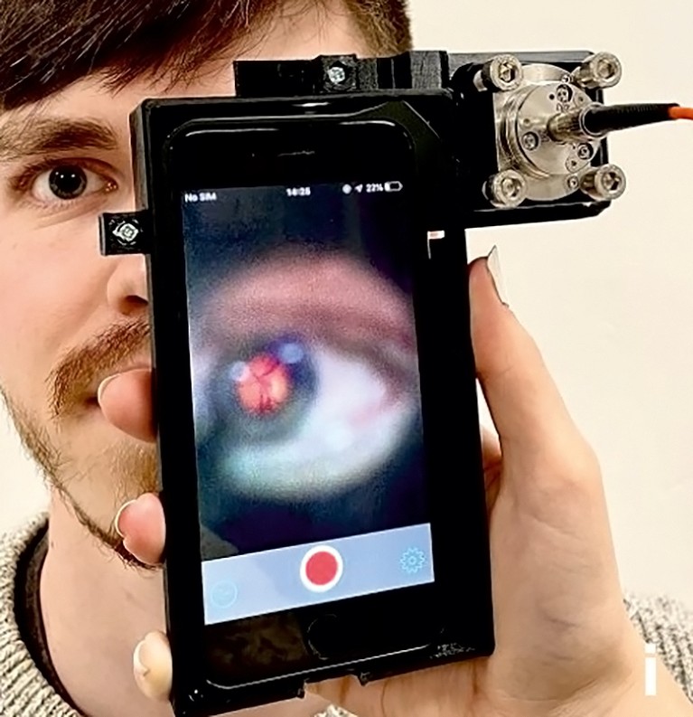 A closeup of an eye with a laser is seen through a mobile phone screen in front of someone’s face. A device is attached to it.