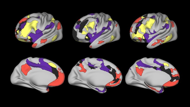 Brain scans showing expansion of the salience network (black) and contraction of other networks (red, yellow and purple) in individuals with depression.