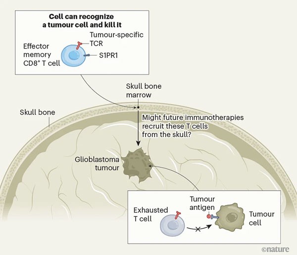 Infographic illustrating that tumour-reactive immune cells are present in the skull bone marrow of people who have brain tumours.