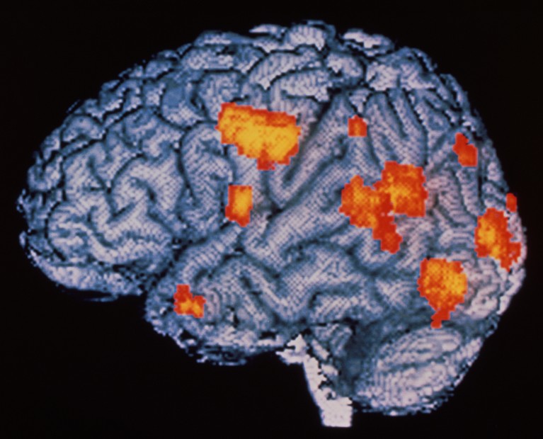 Exploración cerebral PET en color de un paciente con esquizofrenia durante alucinaciones, con actividad resaltada en rojo y amarillo