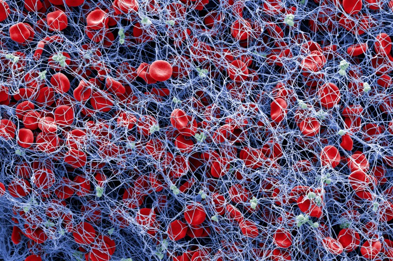 A coloured scanning electron micrograph of red blood cells and platelets in a fibrin mesh in blue and red colours