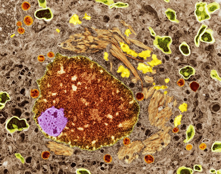 A transmission electron micrograph showing a neuron in Alzheimer's disease