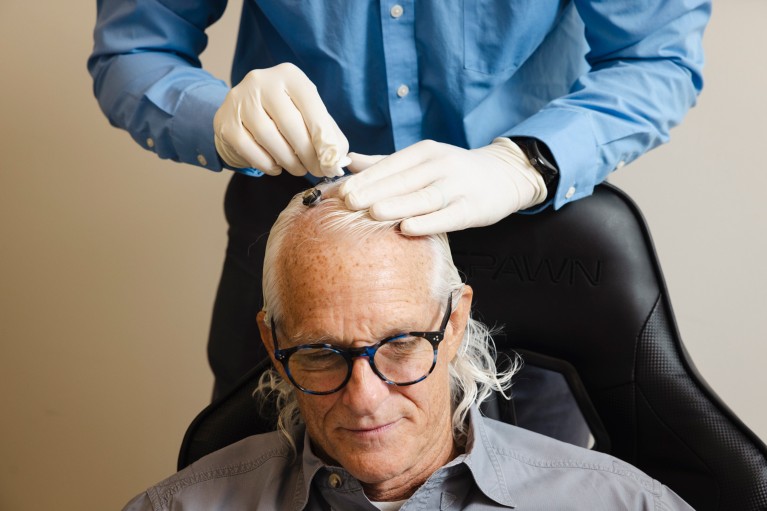 A close-up of a person cleaning the pedestals on Scott Imbrie’s scalp