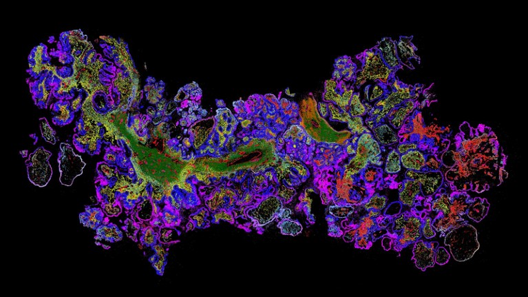 MERSCOPE data image of human ovarian cancer tissue displaying genes represented by different colours