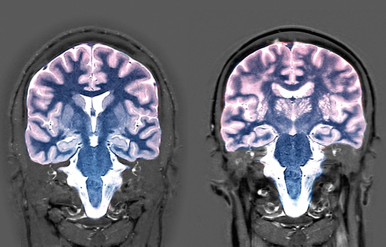 Coloured MRI scans of frontal sections through two brains.