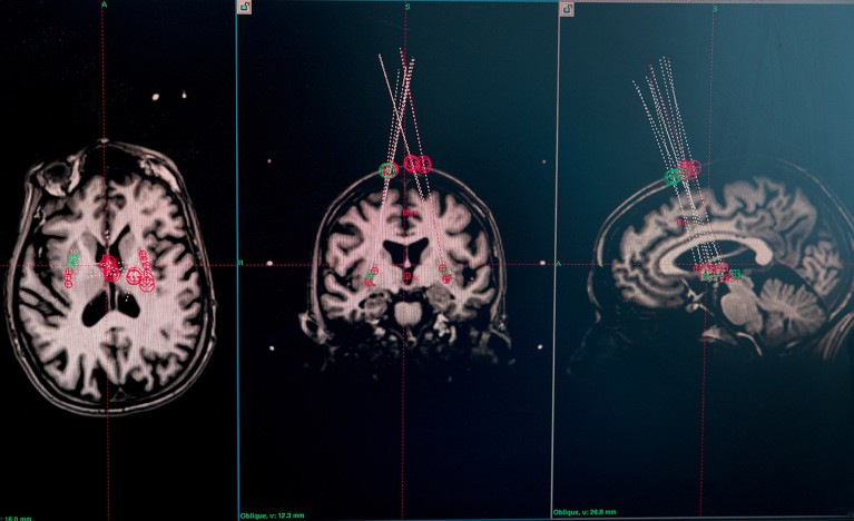 Scansioni MRI cerebrali di un partecipante allo studio.