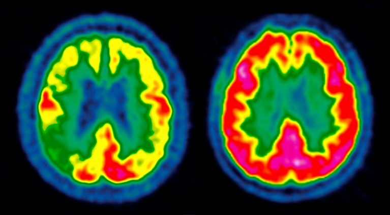 Coloured PET scan of the brain of a patient with Alzheimer's disease compared with a normal brain on a black background