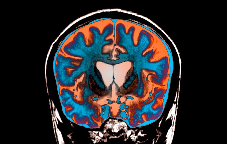 FLAIR magnetic resonance imaging (MRI) scan of a coronal section through the brain of a 21-old patient with Huntington's disease.