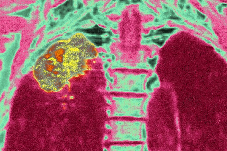 A coloured X-ray showing a large tumour, yellow, in the lung of a patient