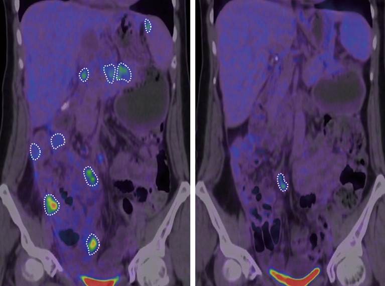 Imagens de PET-CT de câncer de ovário primário com metástase abdominal destacadas em círculos pontilhados brancos antes e depois do tratamento