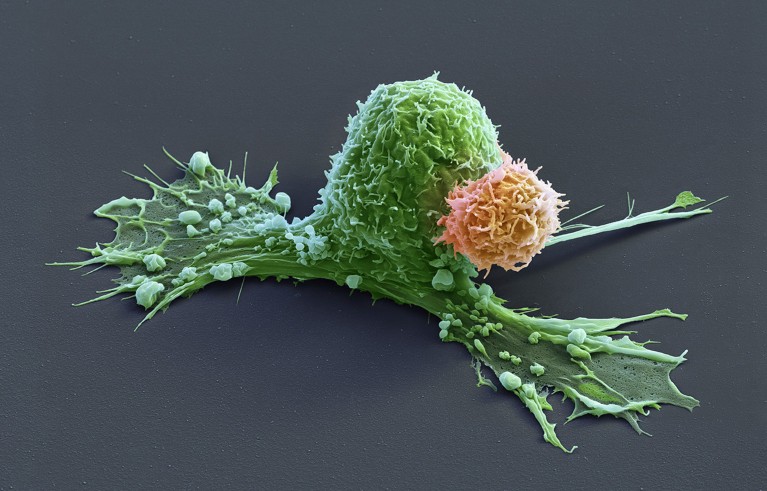 Coloured scanning electron micrograph of a cancer cell (green) where a CAR T-cell (orange) has made contact and the cancer cell is starting to contract.