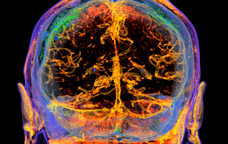 Coloured 3D CT scan of the head of a patient showing healthy cerebral arteries in orange, green and purple colours