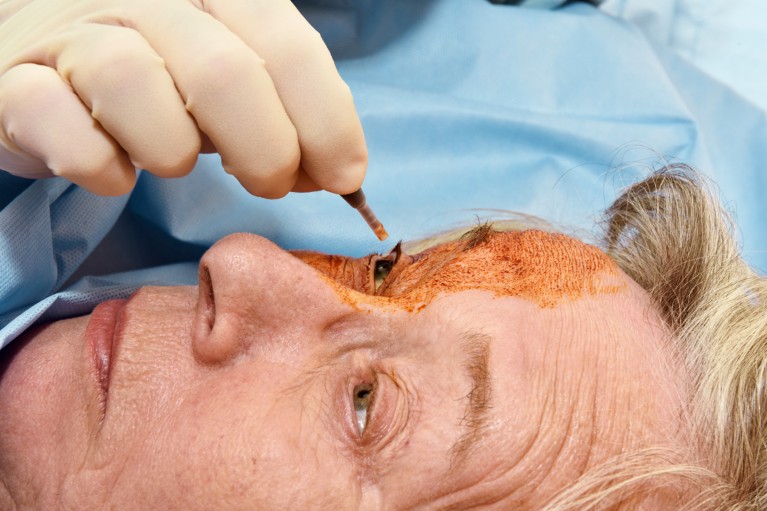 A close-up of a gloved hand applying brown iodine eyedrops to a patient lying down