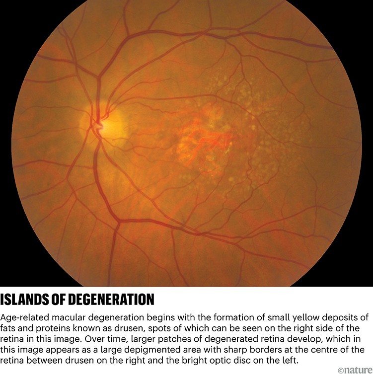 A retina image explains age-related macular degeneration.