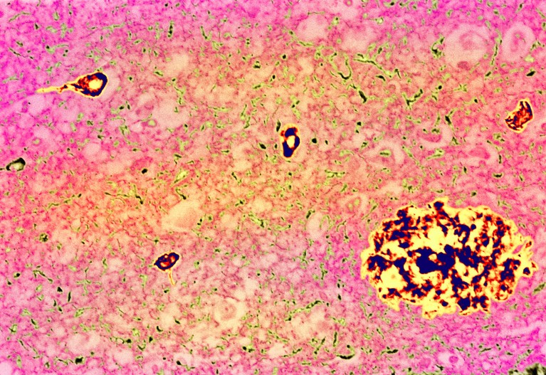 Micrografia leggera colorata del tessuto cerebrale dal malato di una malattia di Alzheimer. A destra in basso a destra è una grande placca (gialla/nera) contenente l'amiloide proteica anormale.