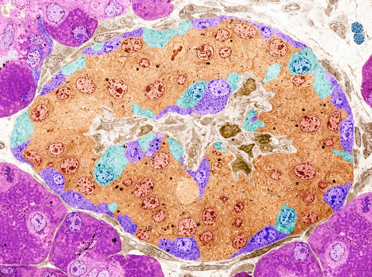 CRISPR-edited pancreas cells allow diabetics to skip immune-dampening drugs