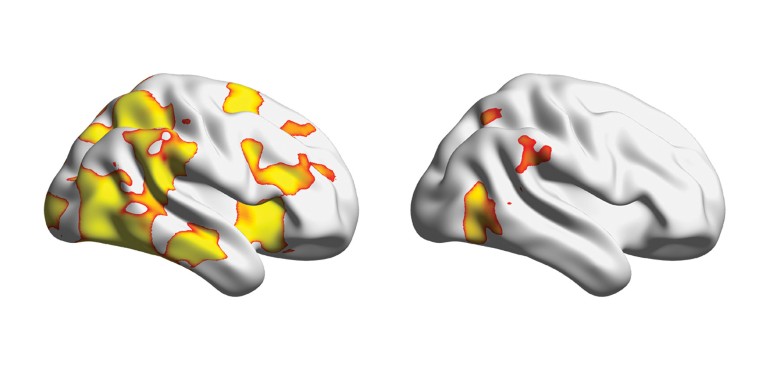 Side-by-side images of two brains. Each brain is mostly white, with varying amounts of yellow, orange, and red colouration on them.