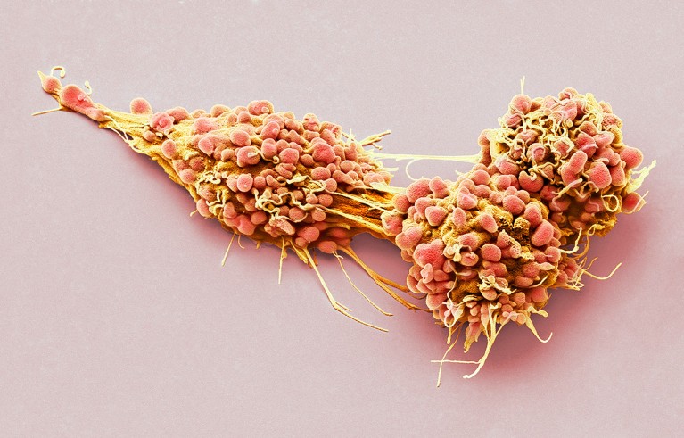 Coloured scanning electron micrograph of a lumpy fibrous mass of ovarian cancer cells.