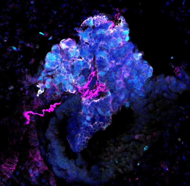 A microscope image of neurons infiltrating a tumour