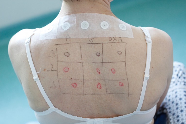 The bare back of a woman showing an allergens test grid.