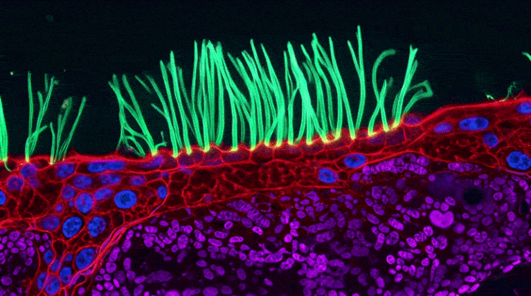 Diffractive super-resolution microscopy sequence of beating airway cilia from a child with primary ciliary dyskinesia.