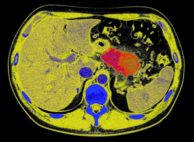 Colour-enhanced CT scan of the abdomen in yellow showing a large tumour in the pancreas in red, on a black background
