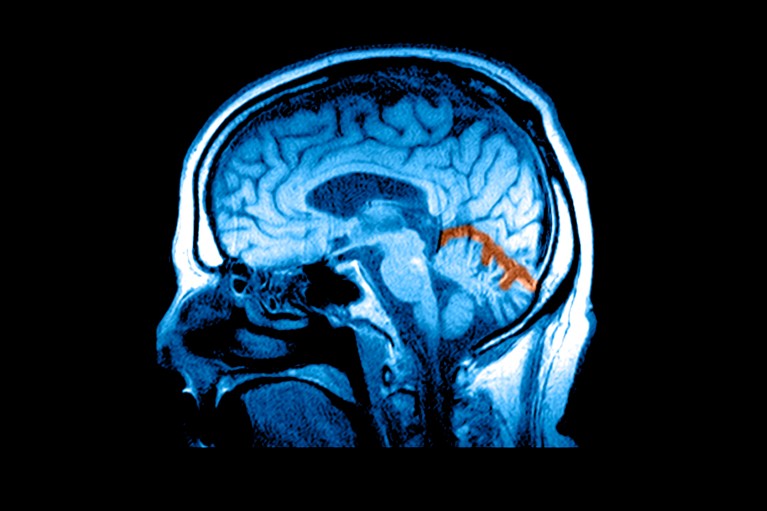 MRI scan of a human head, showing a side view of the brain with a small orange-highlighted region in the lower rear area.